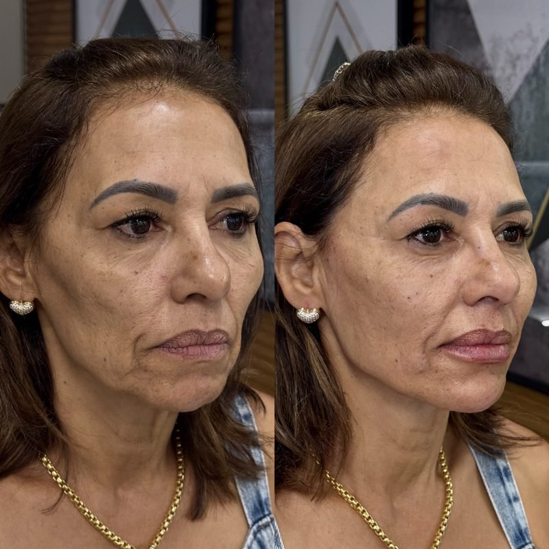 Antes e depois de harmonização facial