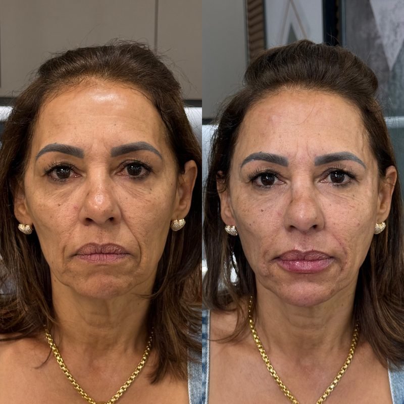 Antes e depois de harmonização facial