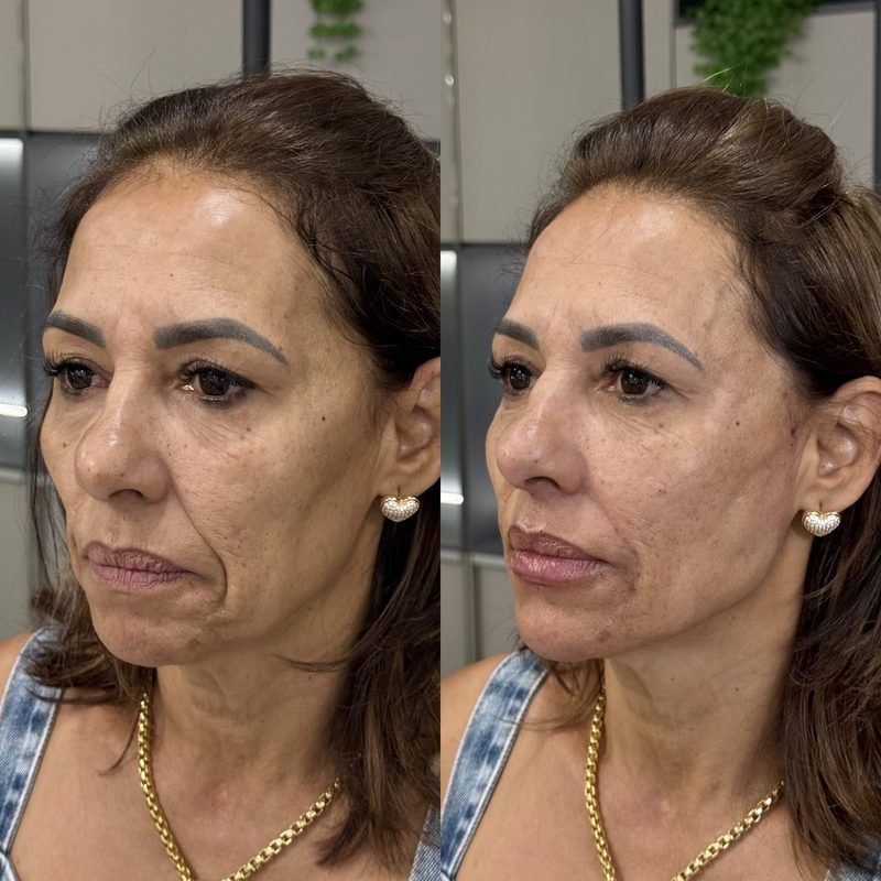 Antes e depois de harmonização facial