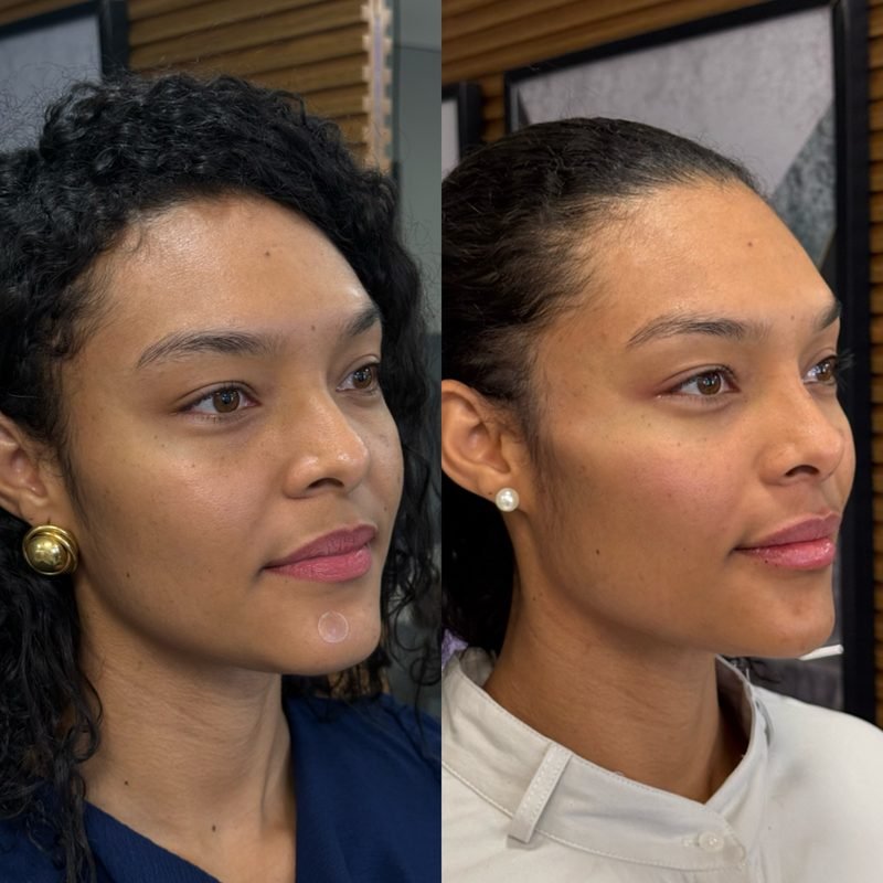 Antes e depois de harmonização facial