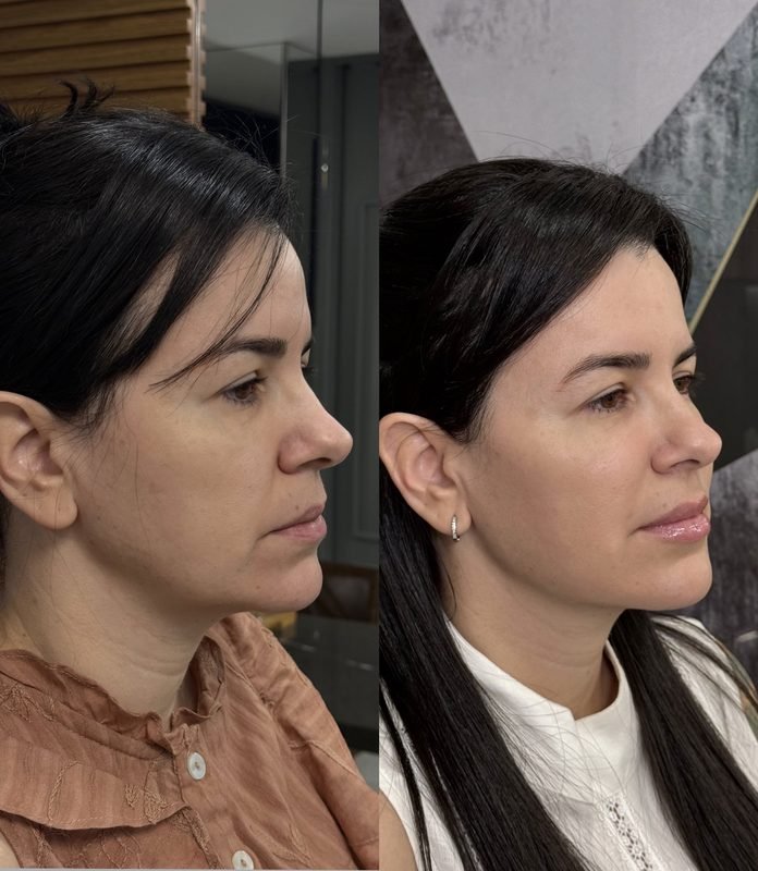 Antes e depois de harmonização facial