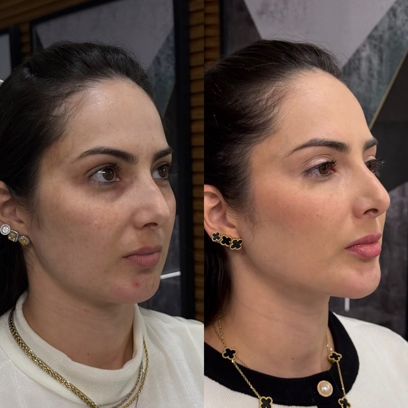 Antes e depois de harmonização facial