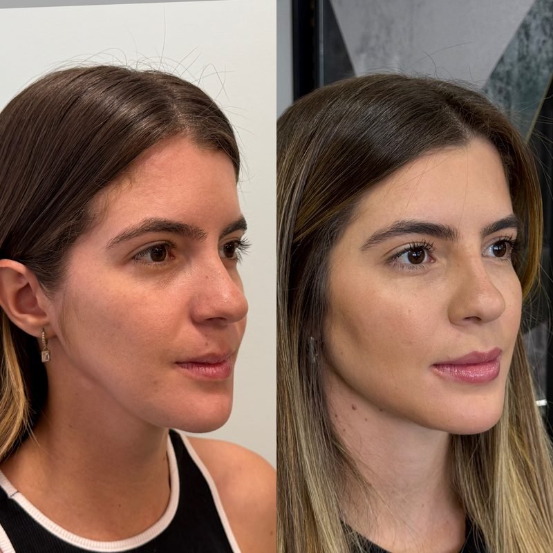 Antes e depois de harmonização facial