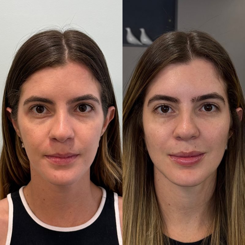 Antes e depois de harmonização facial